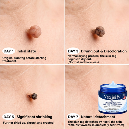 Nexisify® Advanced Correcting Cream for Skin Tags, Moles & Spots – 7‑Day Painless & Scar‑Free – Advanced Care for Skin Imperfections
